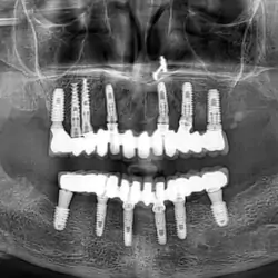 dental-implants