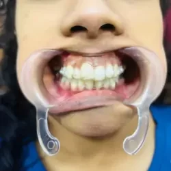 aligners-invisible