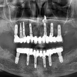 dental-implants